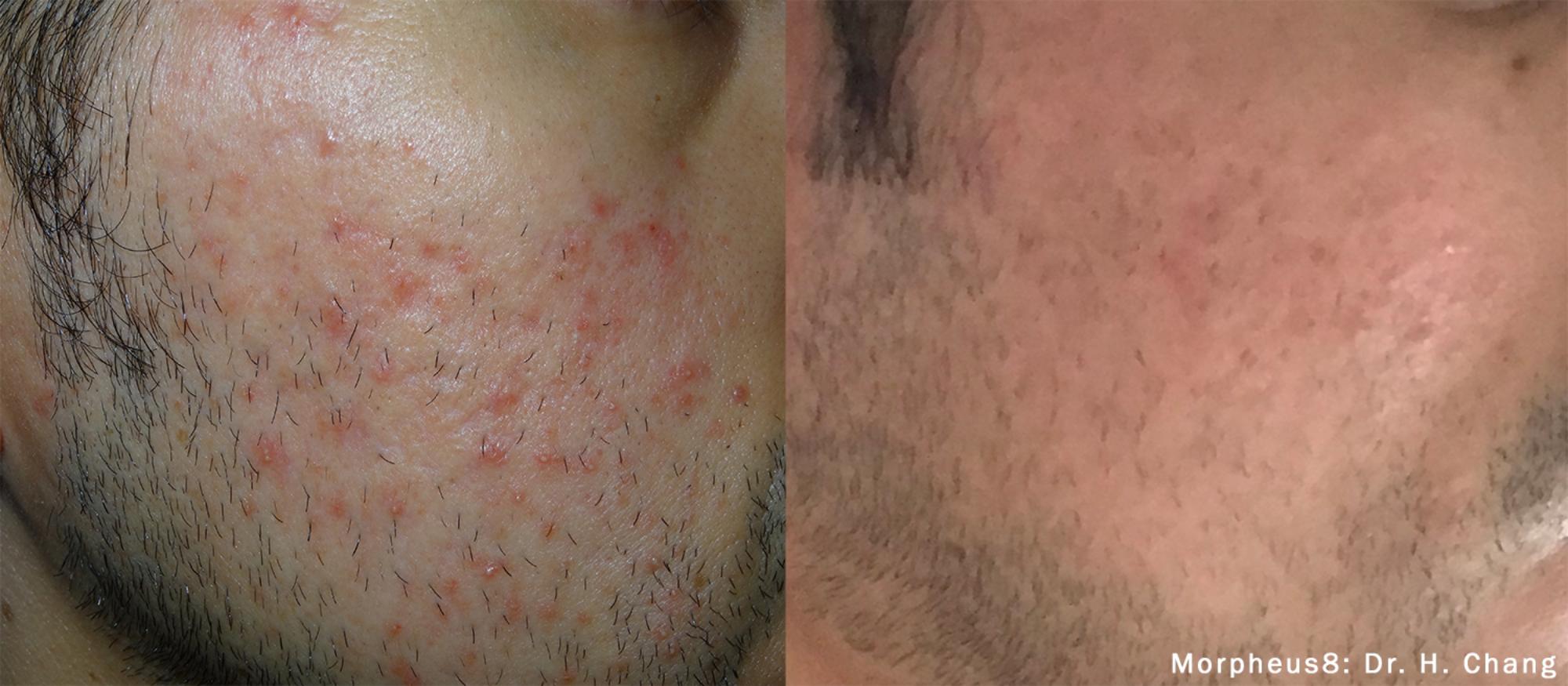 Skin Tightening