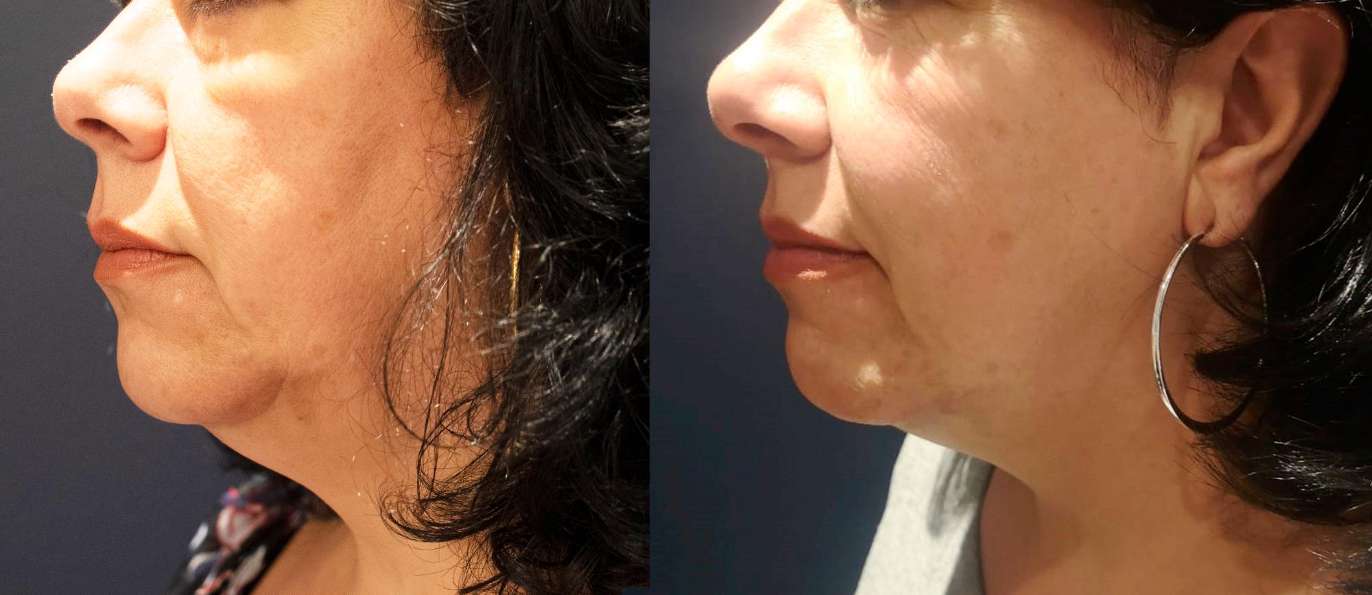 Skin Tightening