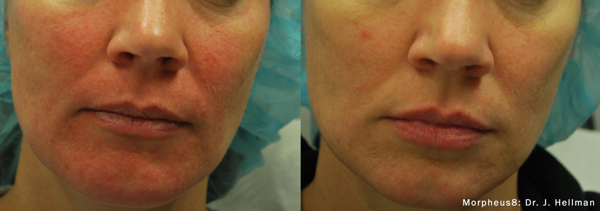Skin Tightening
