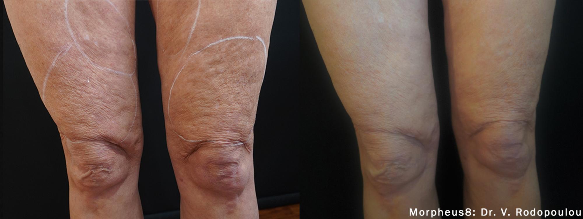 Cellulite Reduction