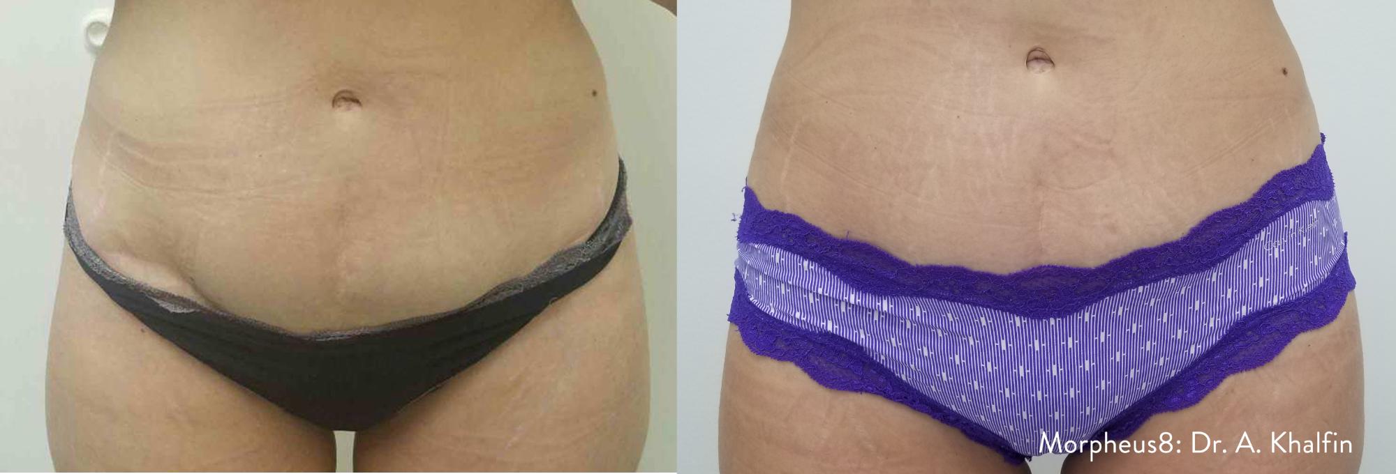Skin Tightening