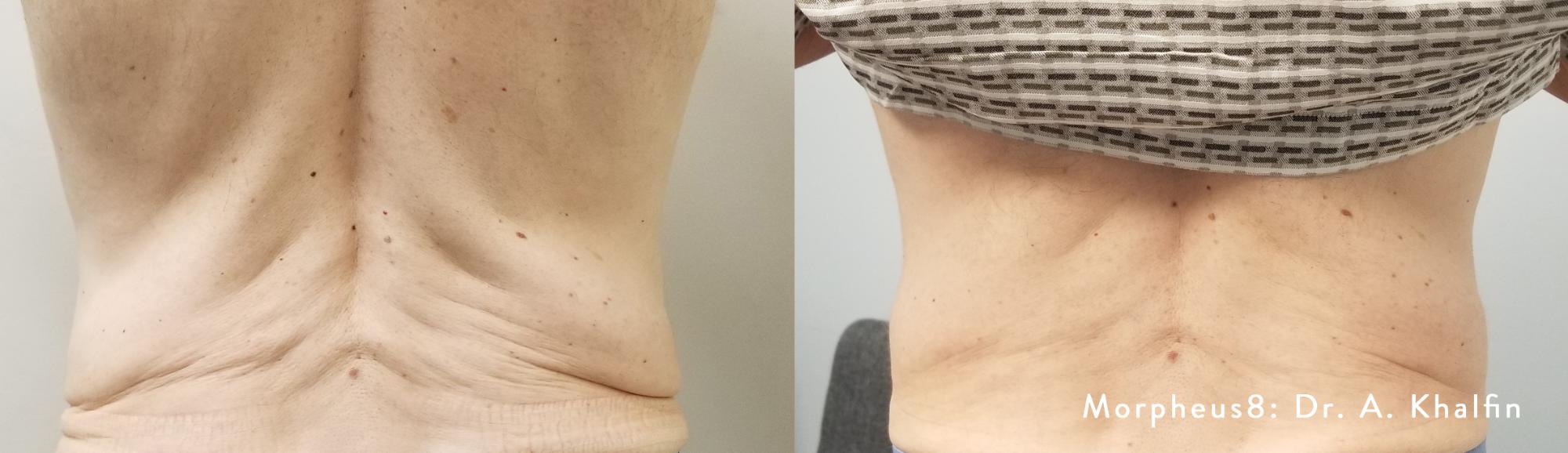 Skin Tightening