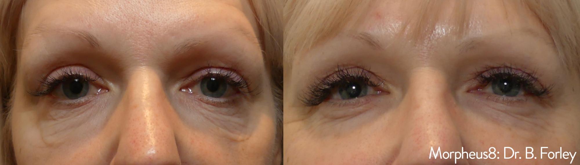 Skin Tightening