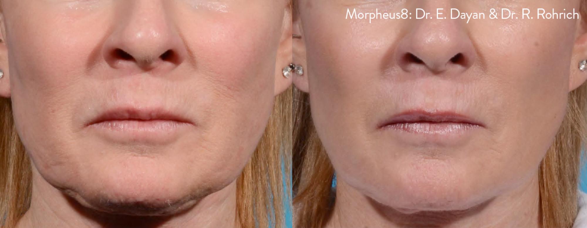 Skin Tightening