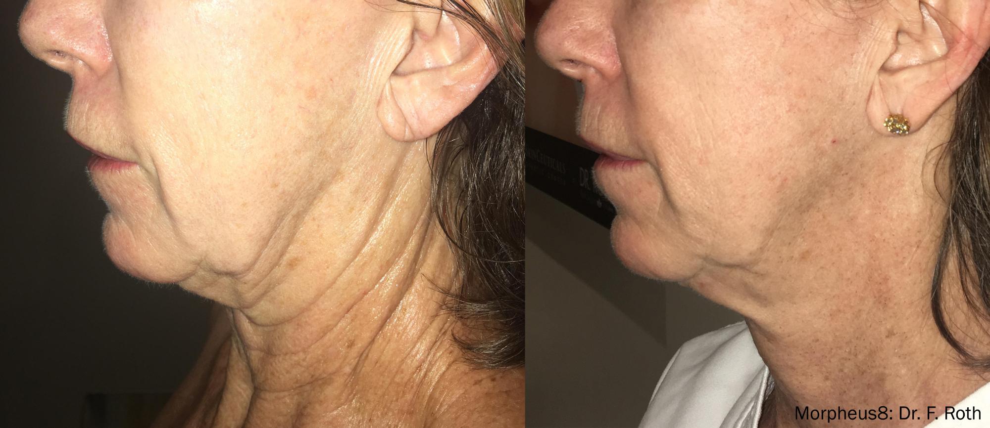 Skin Tightening