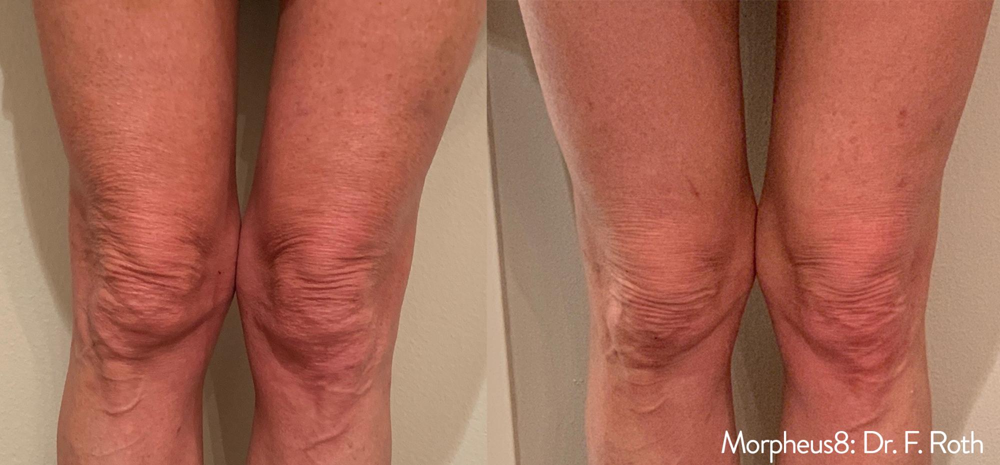 Skin Tightening