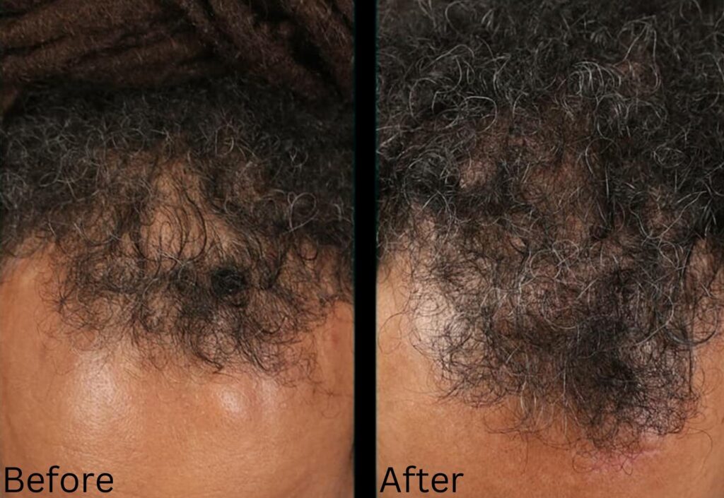 Hair growth & Health