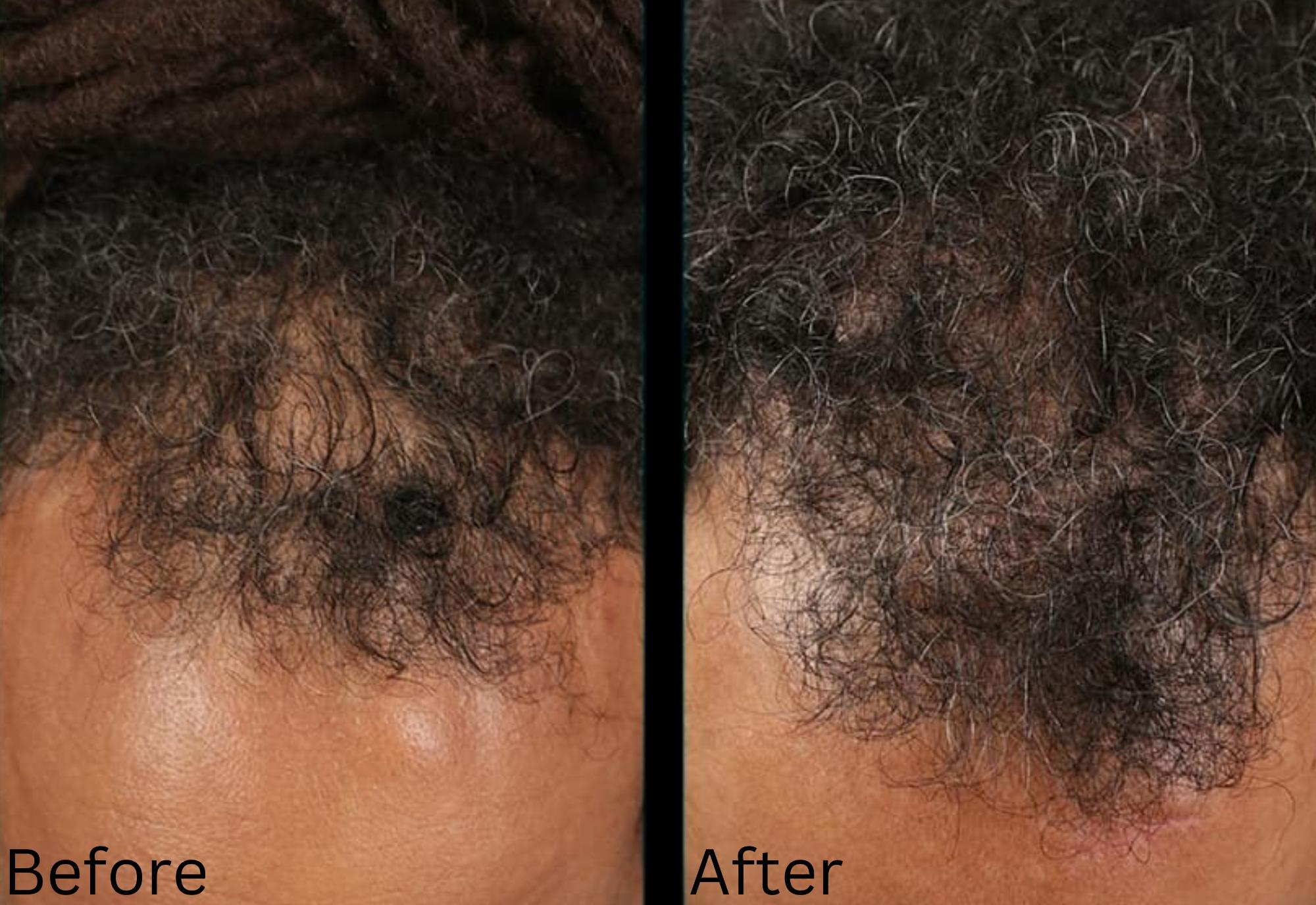 Hair growth & Health