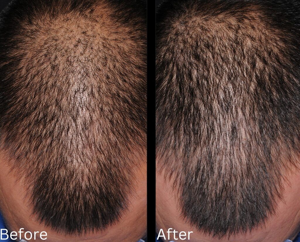 Hair growth & Health