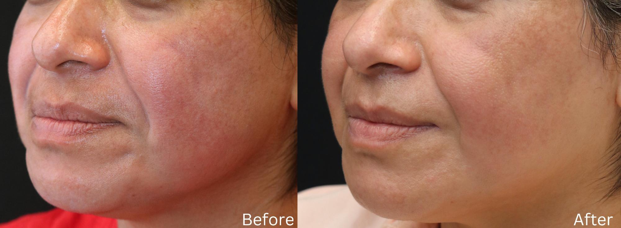 Pigment Removal