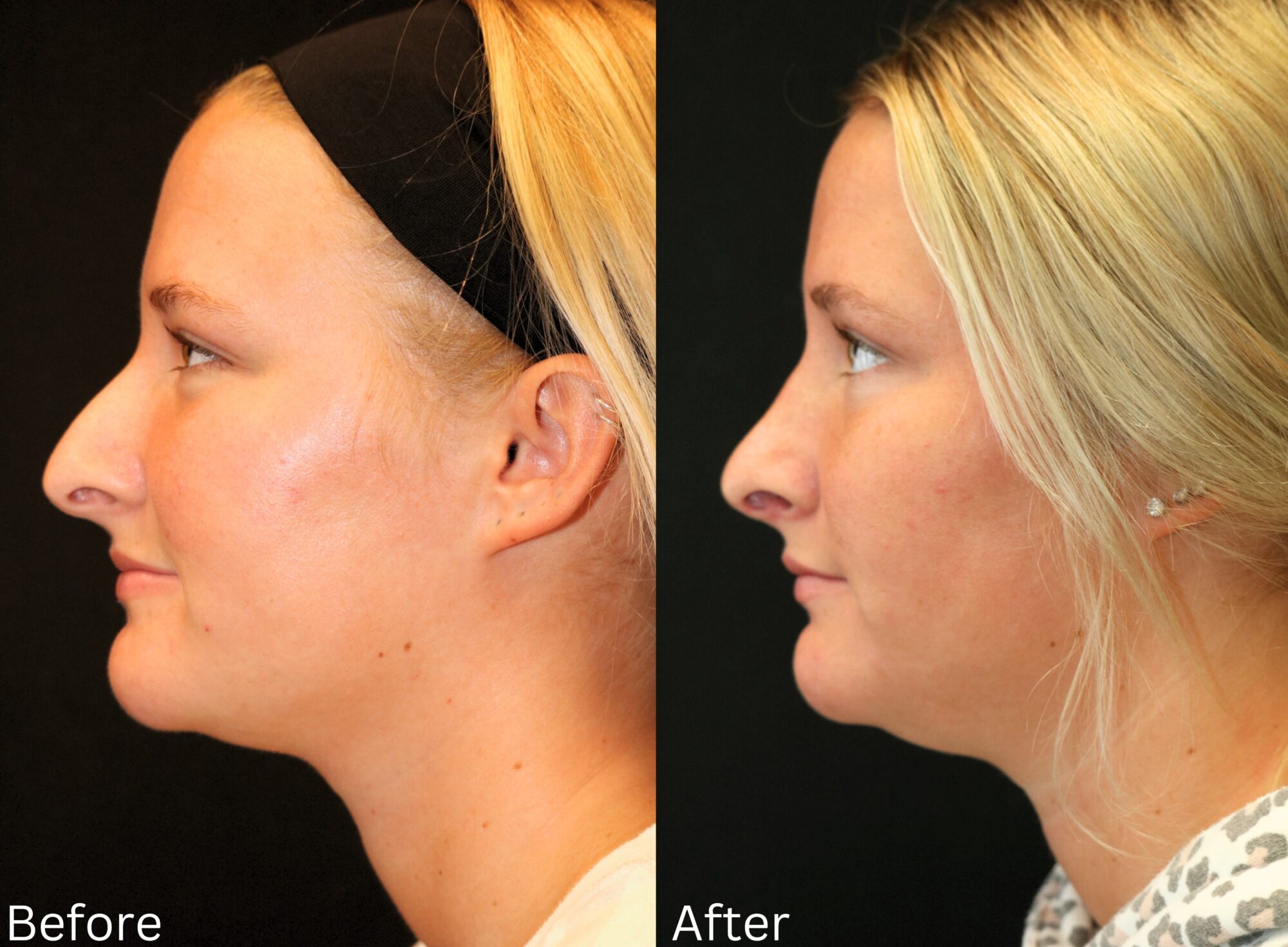 Rhinoplasty