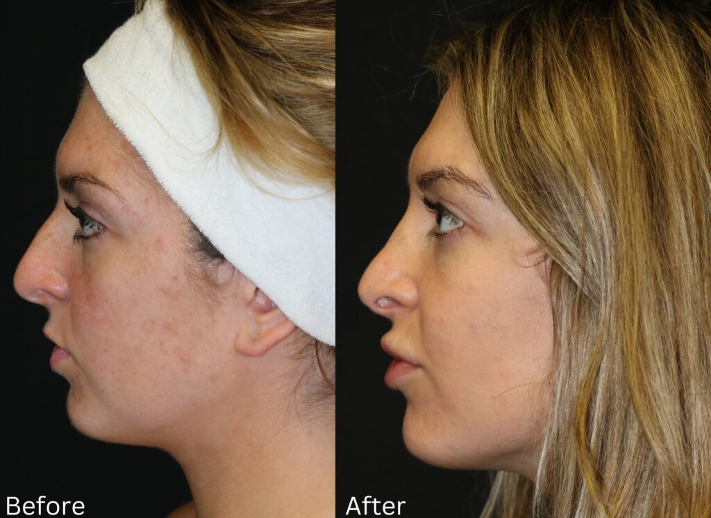 Rhinoplasty