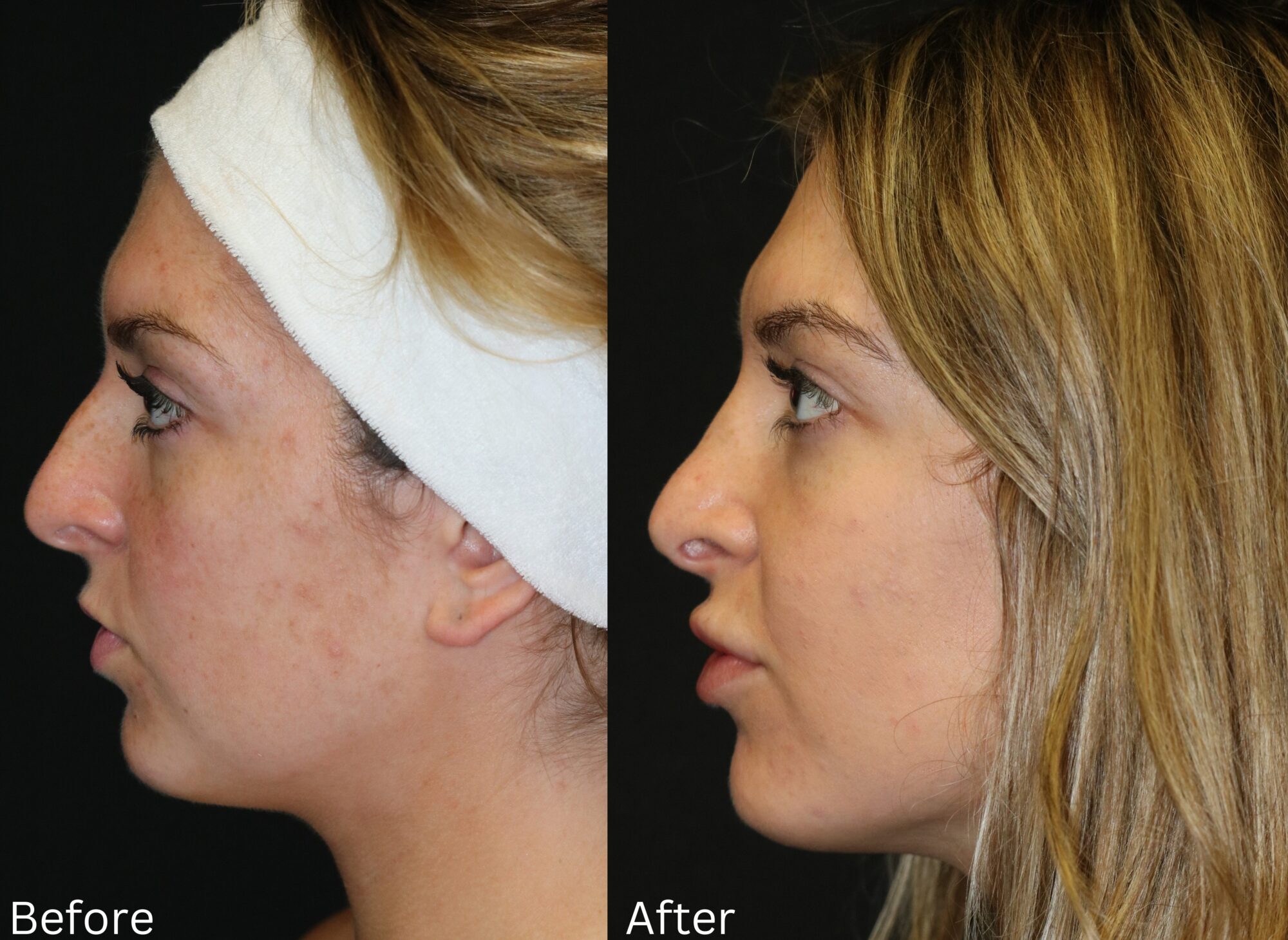 Rhinoplasty