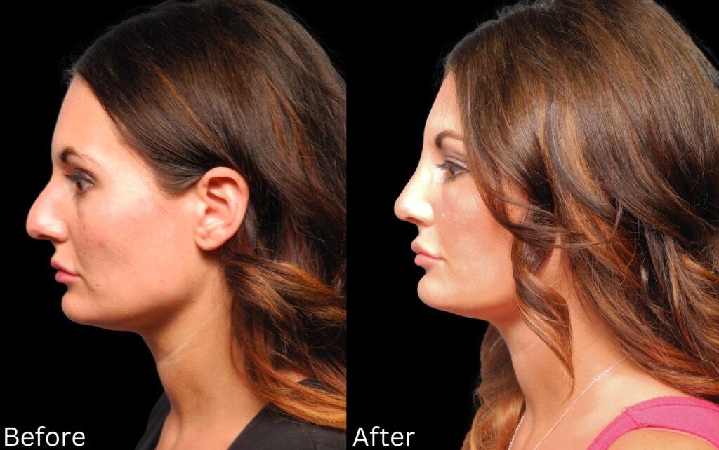 Rhinoplasty