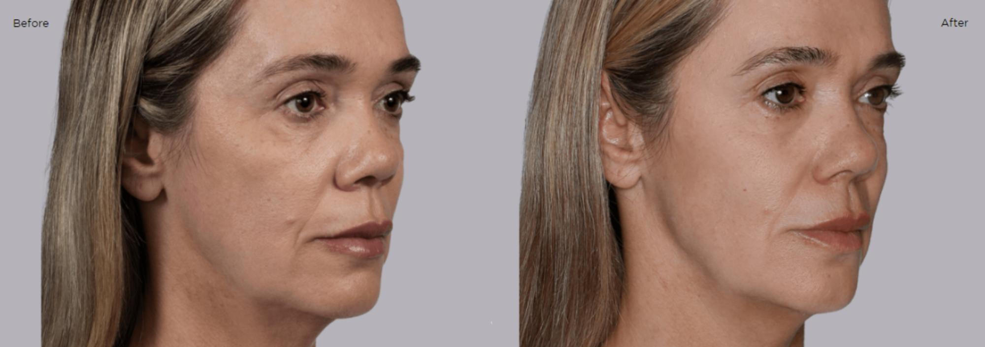 Sculptra