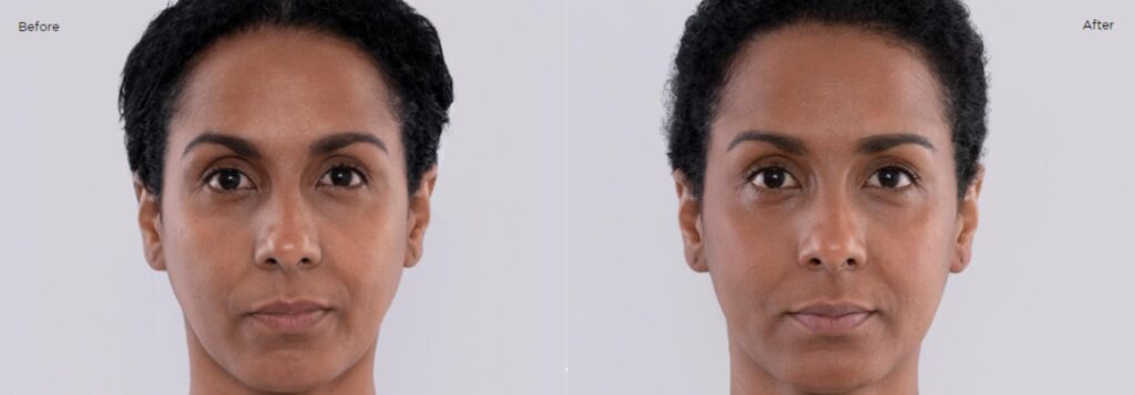 Sculptra