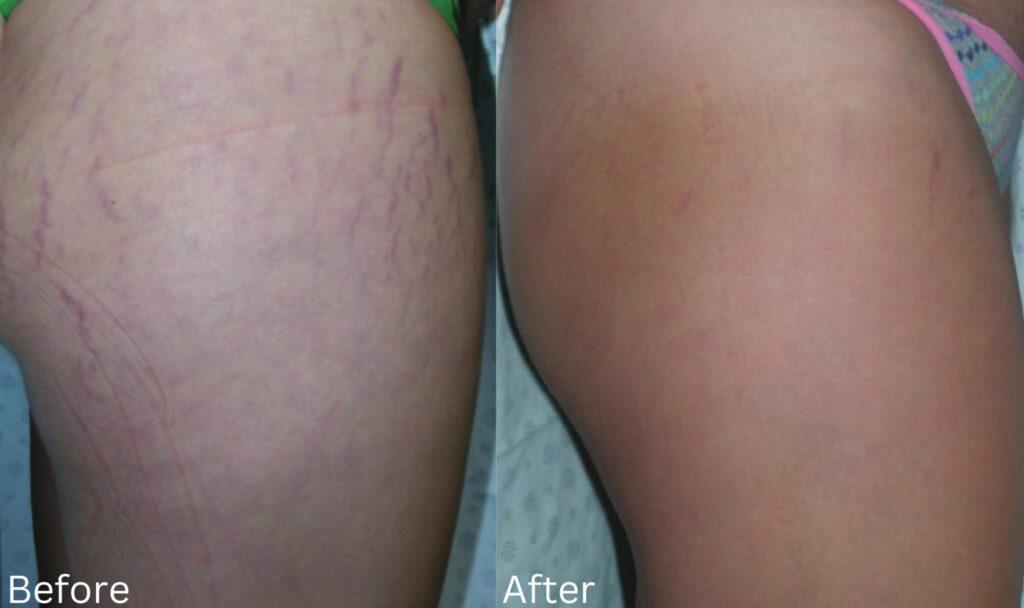 Stretch Marks