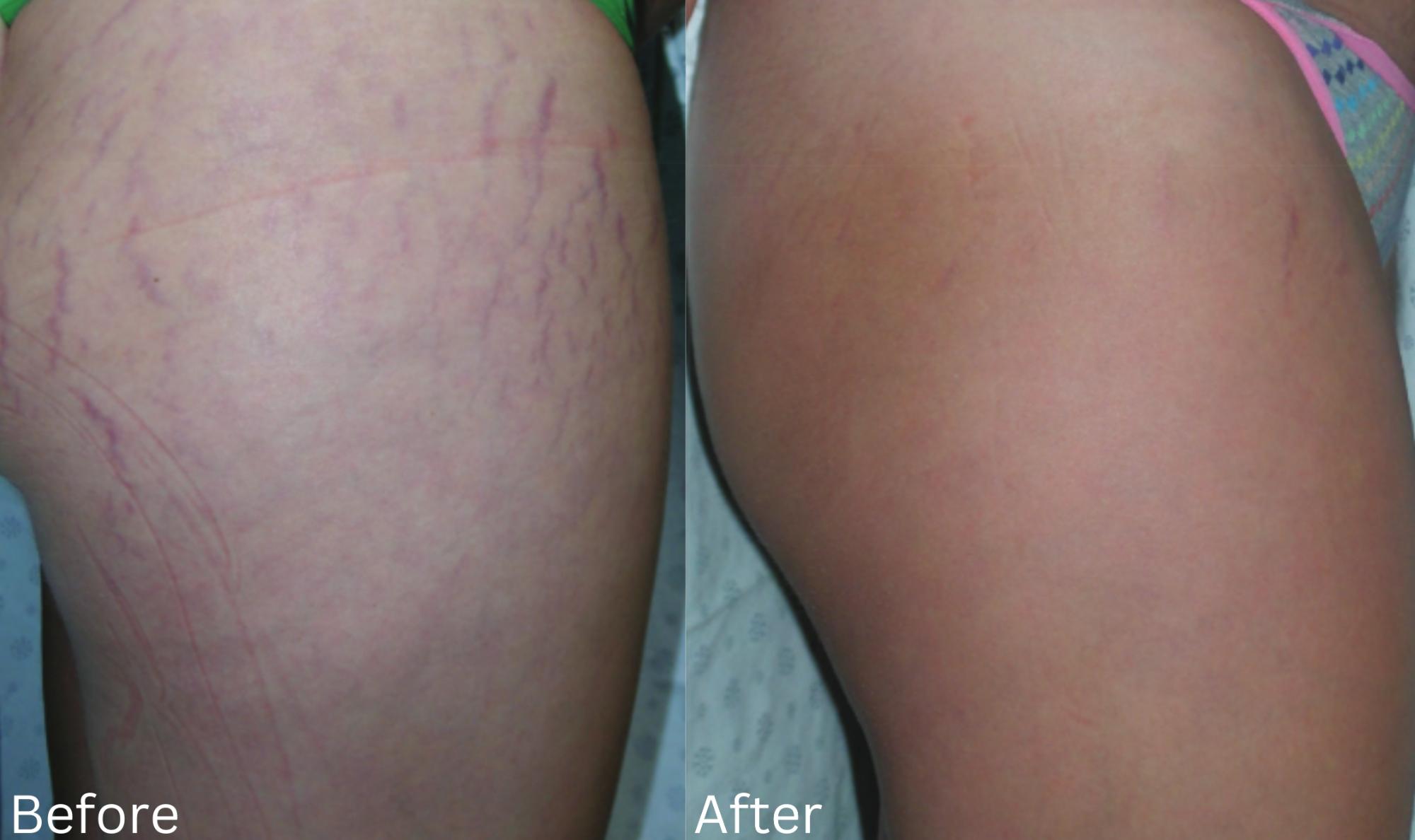 Stretch Marks