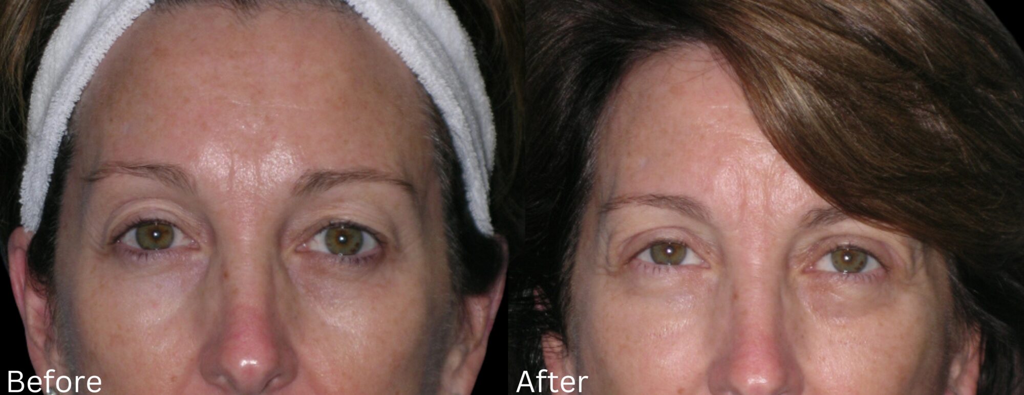 Website BAs - 144 Eyelid Lift