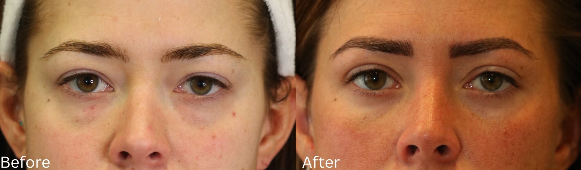 Eyelid Lift