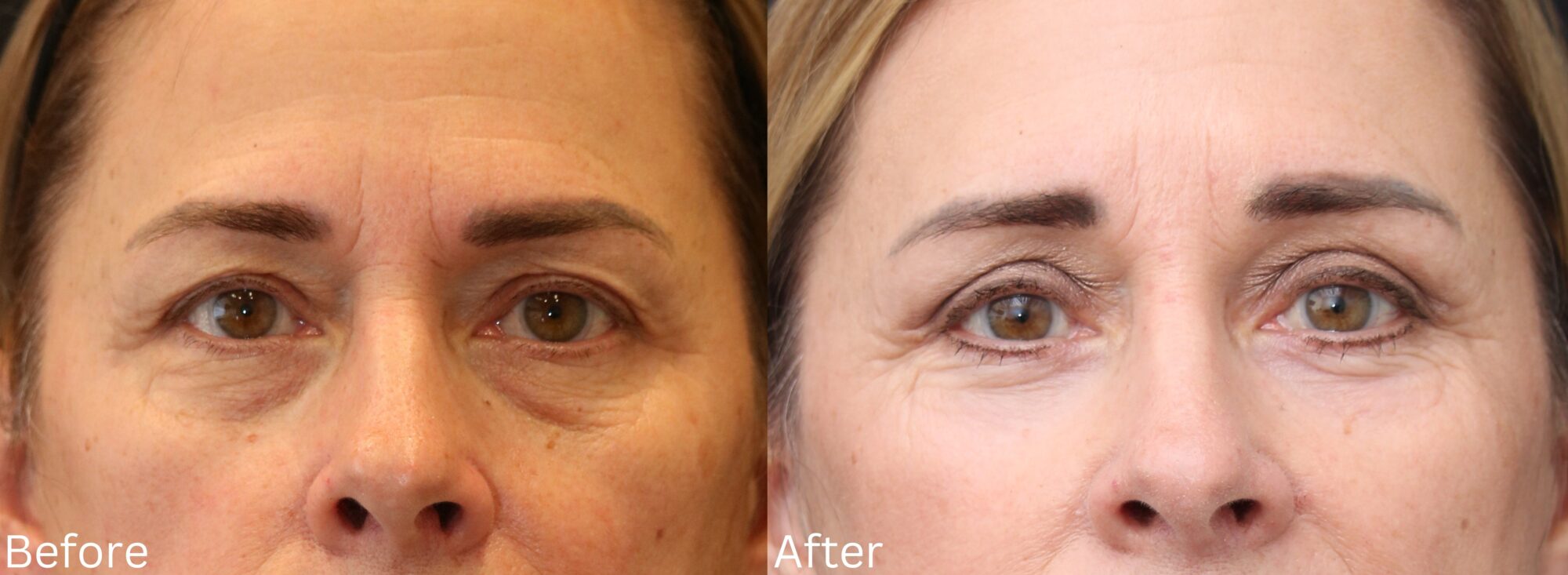 Eyelid Lift