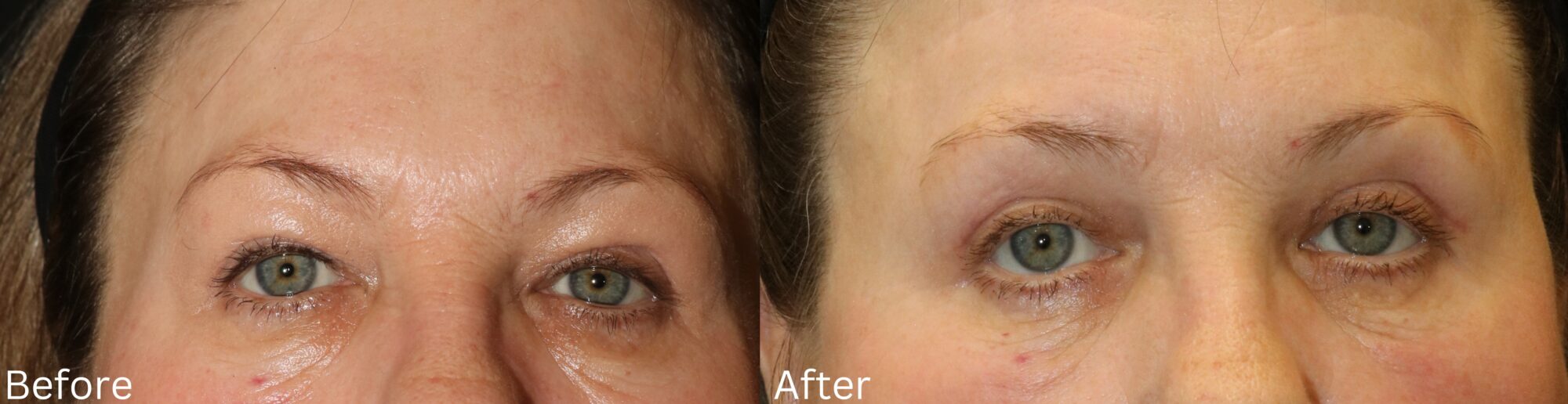 Eyelid Lift