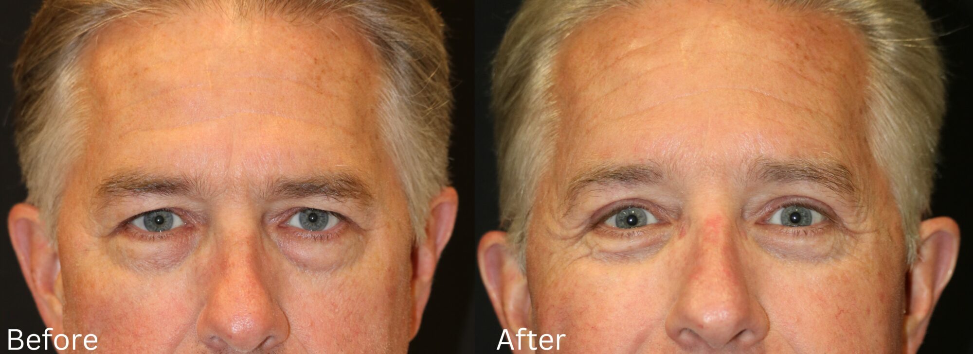 Website BAs - 140 Eyelid Lift