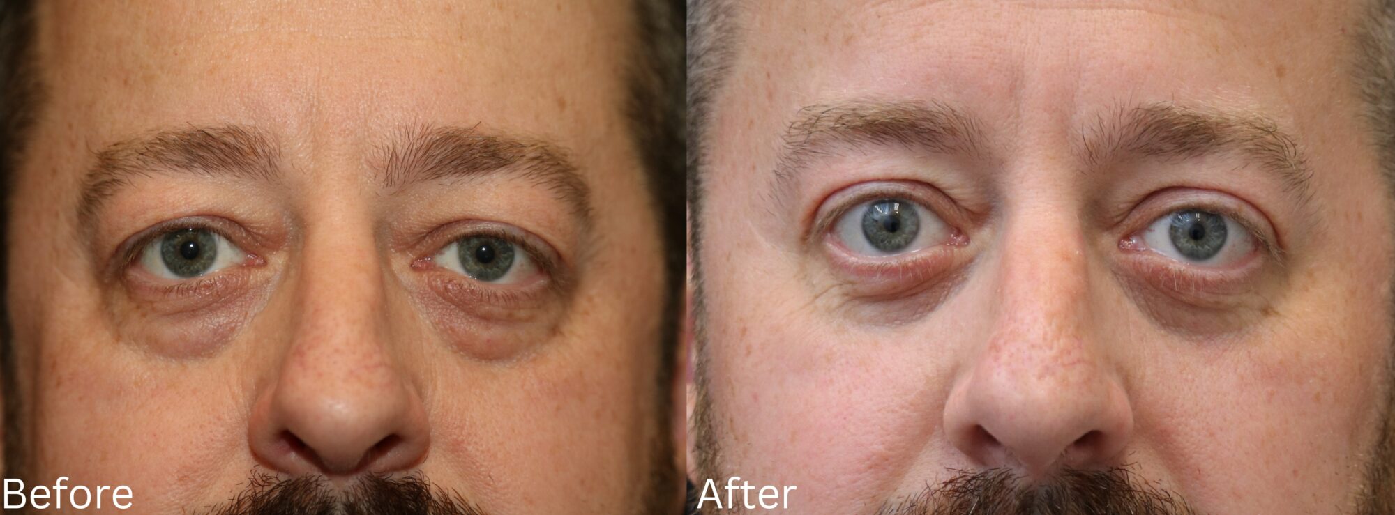 Eyelid Lift