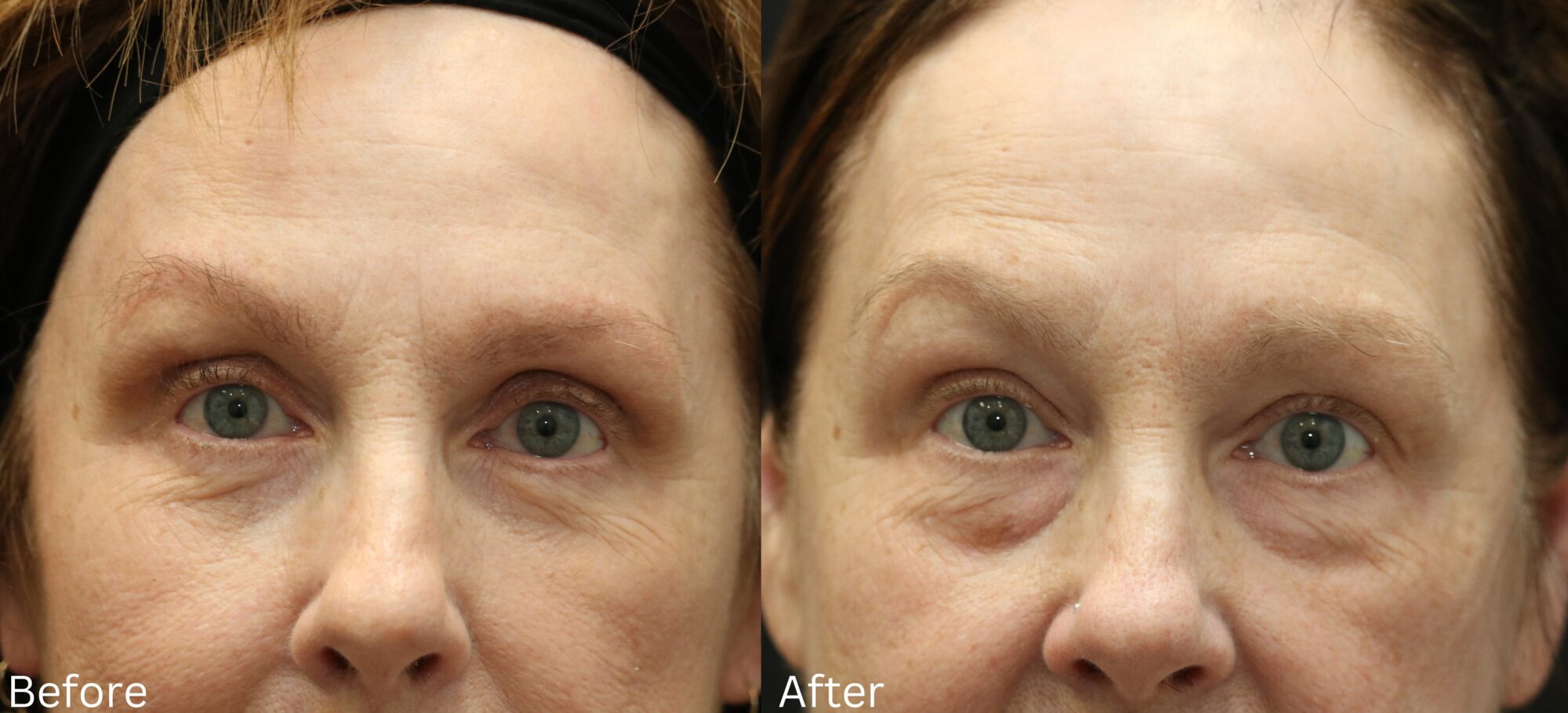 Website BAs - 150 Eyelid Lift