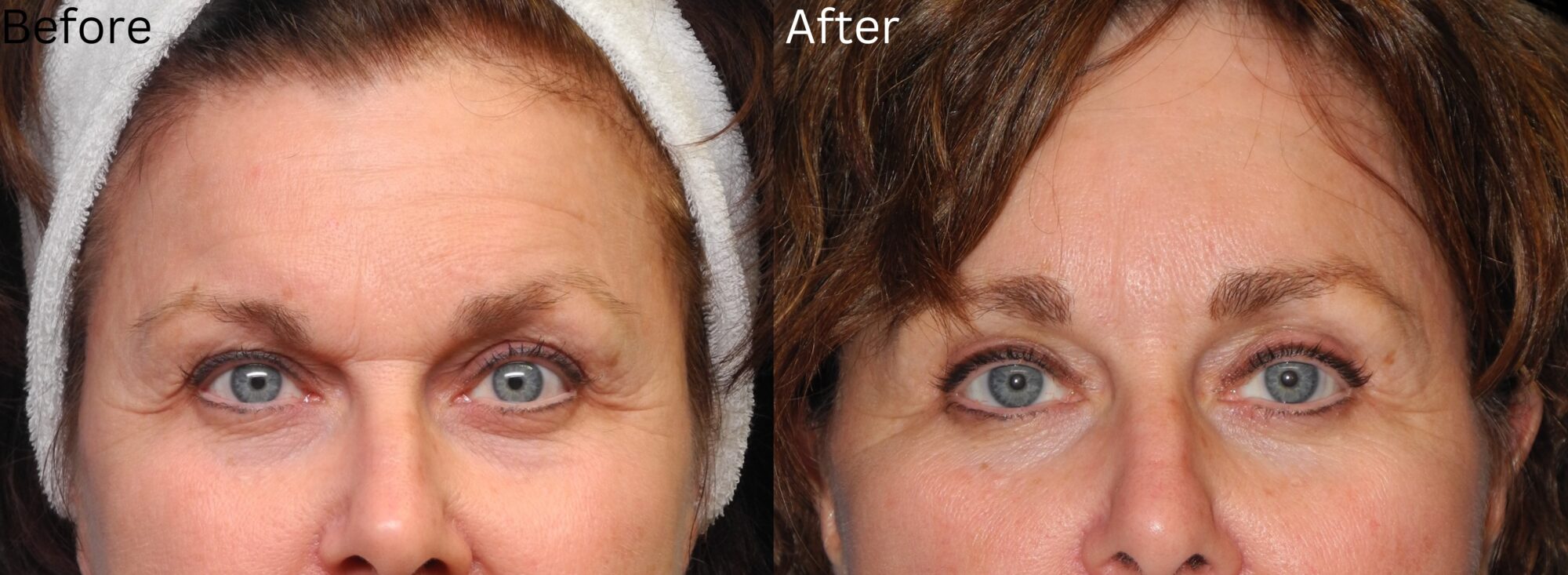 Website BAs - 138 Eyelid Lift