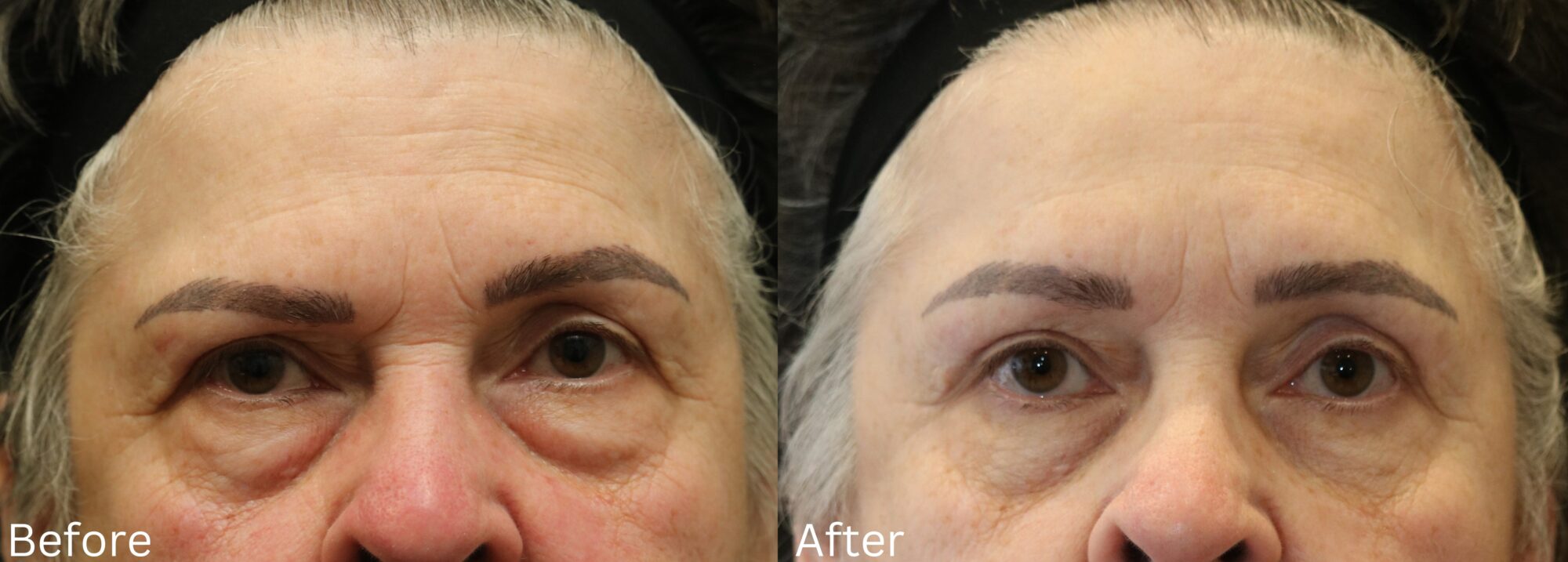 Eyelid Lift