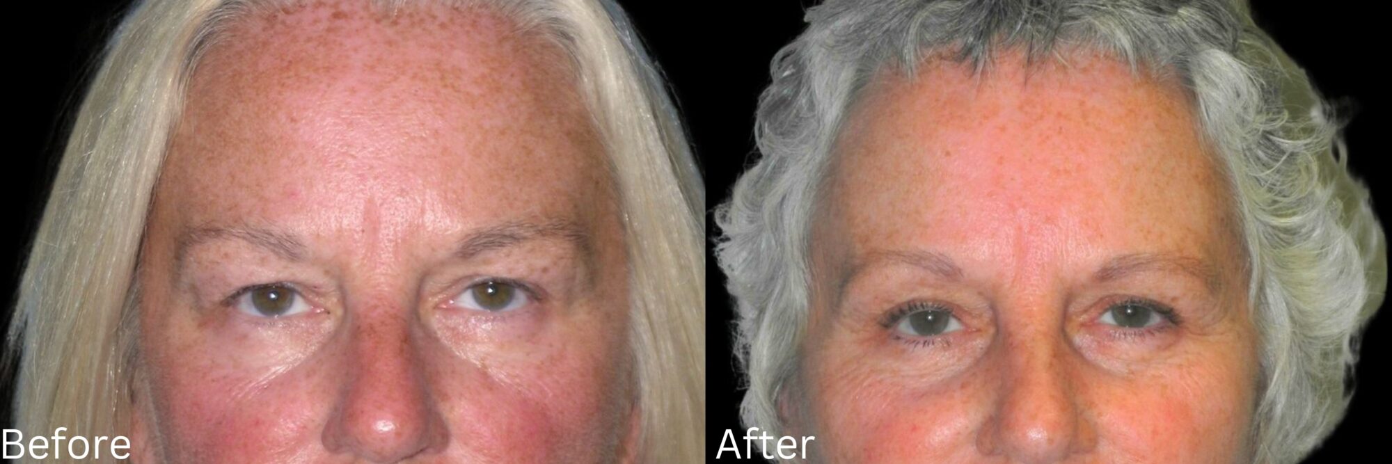 Website BAs - 142 Eyelid Lift