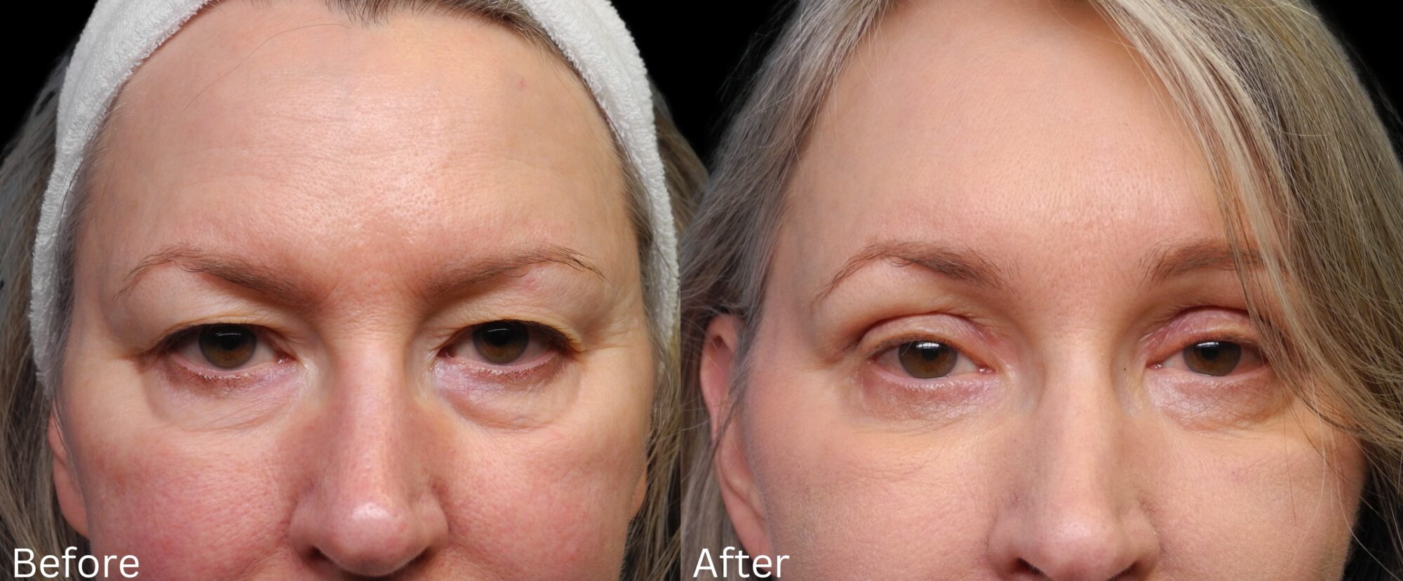 Eyelid Lift