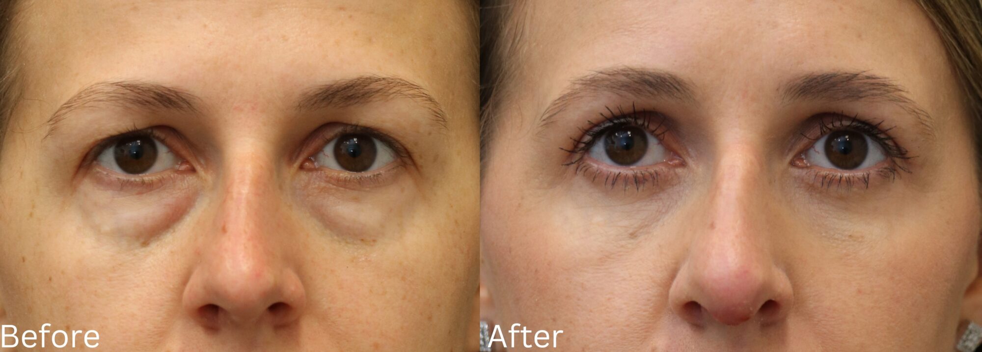 Eyelid Lift