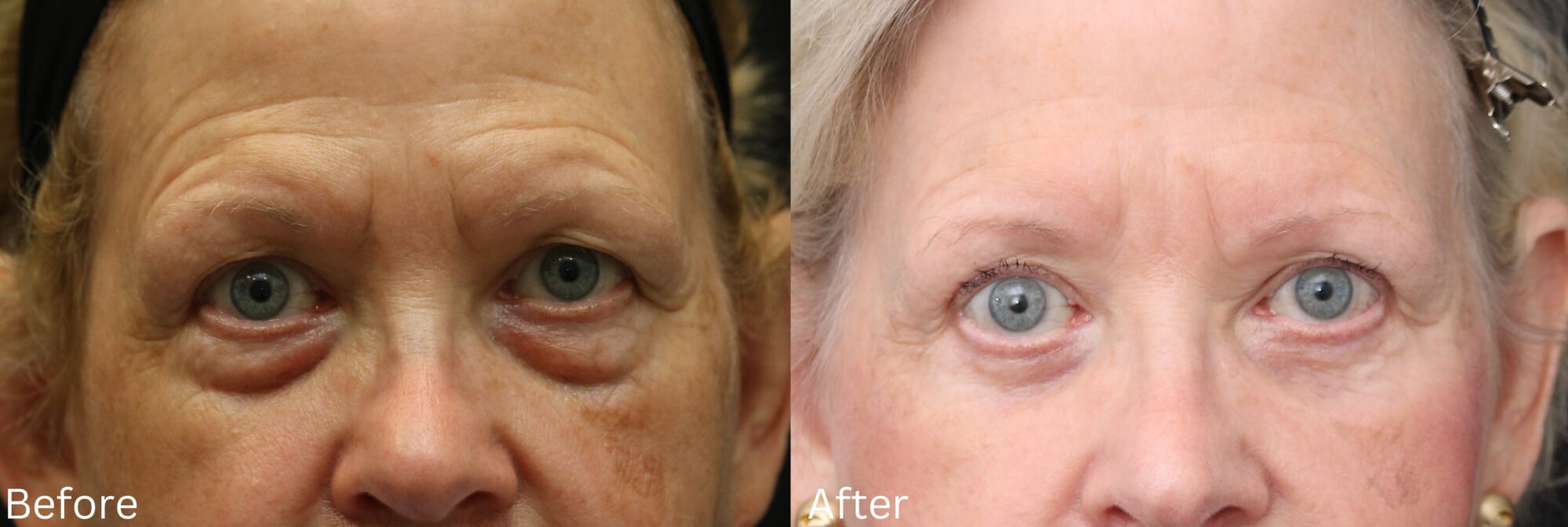 Eyelid Lift
