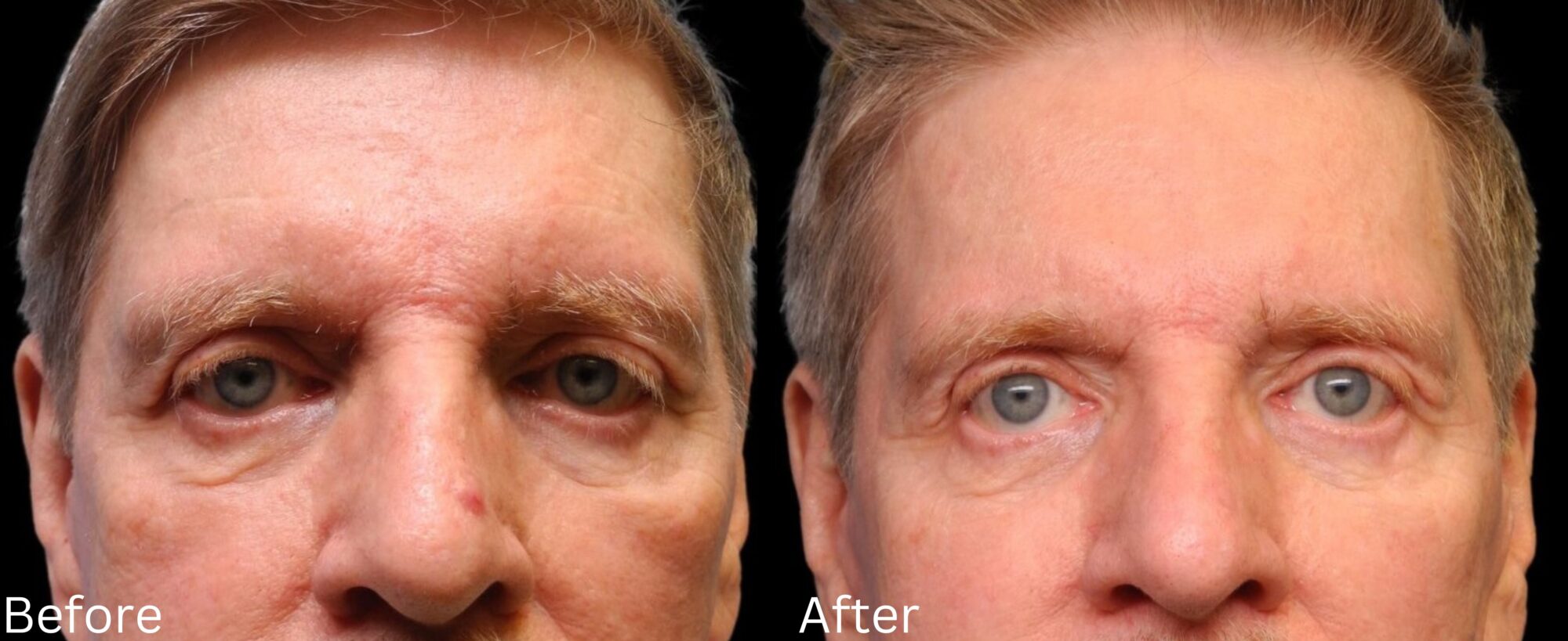 Website BAs - 147 Eyelid Lift