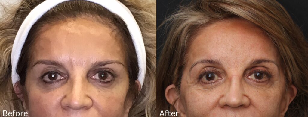 Brow Lift