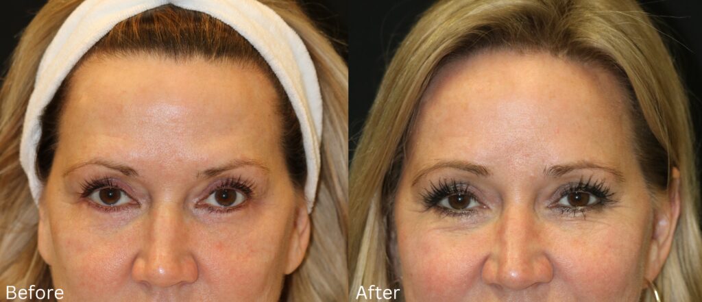 Brow Lift