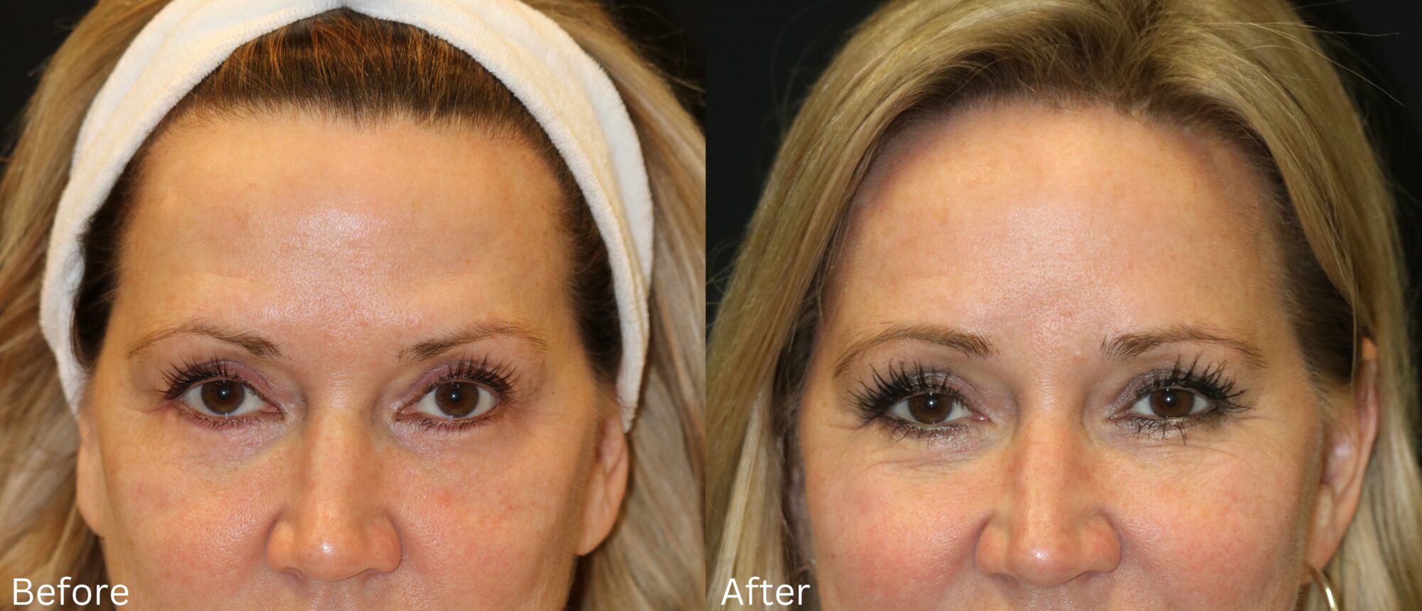 WebsiteBAs2 - 44 Brow Lift