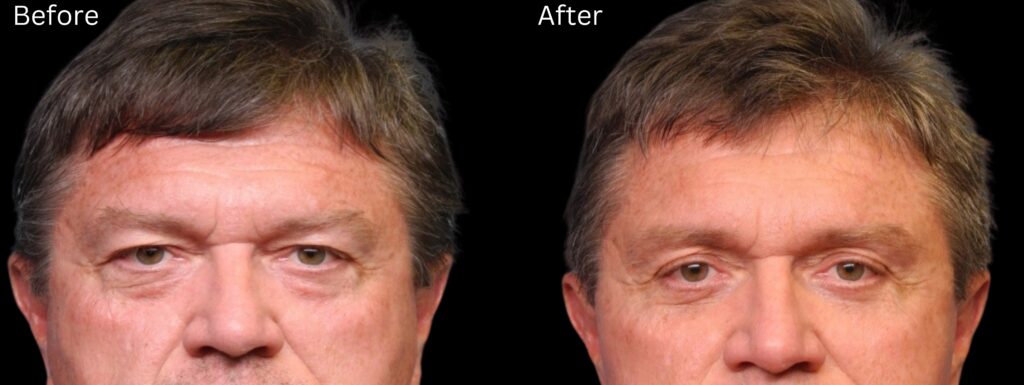 Brow Lift