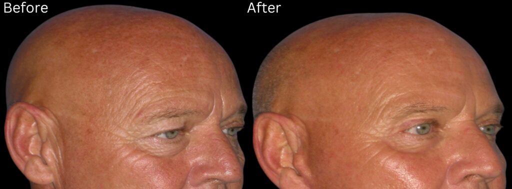 Brow Lift