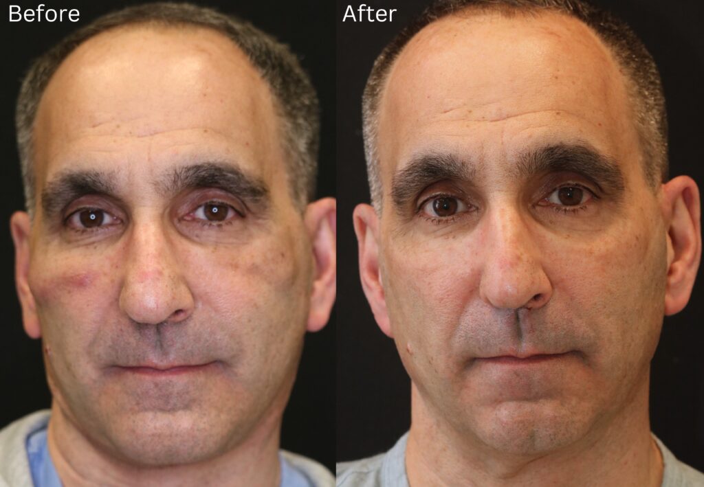Chin Implant