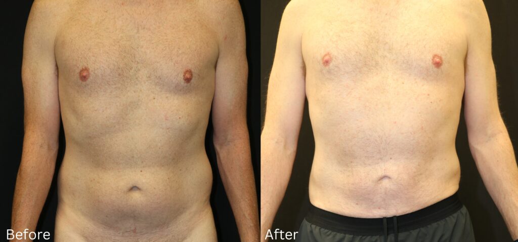 Coolsculpting