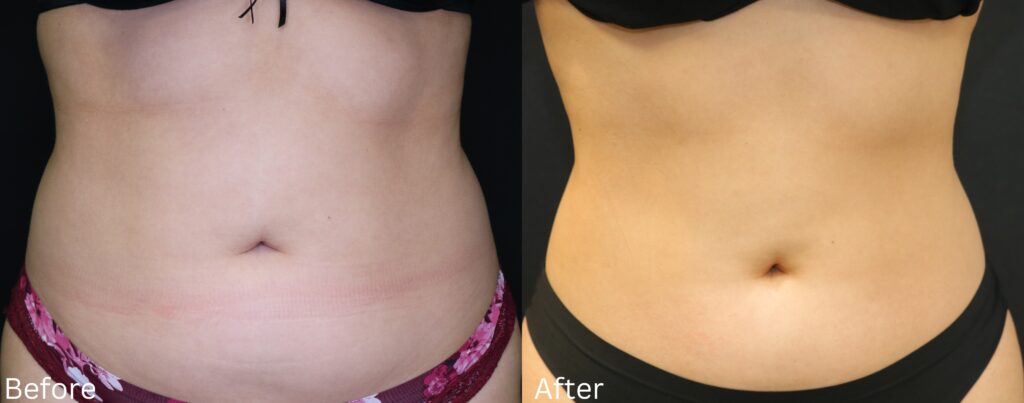 Coolsculpting