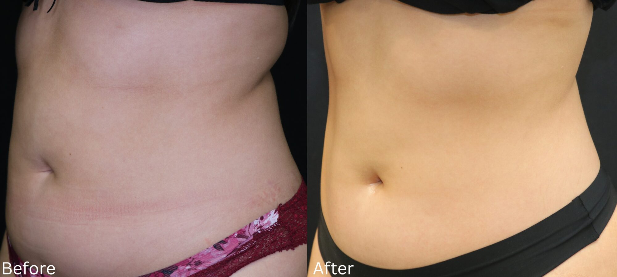 CoolSculpting
