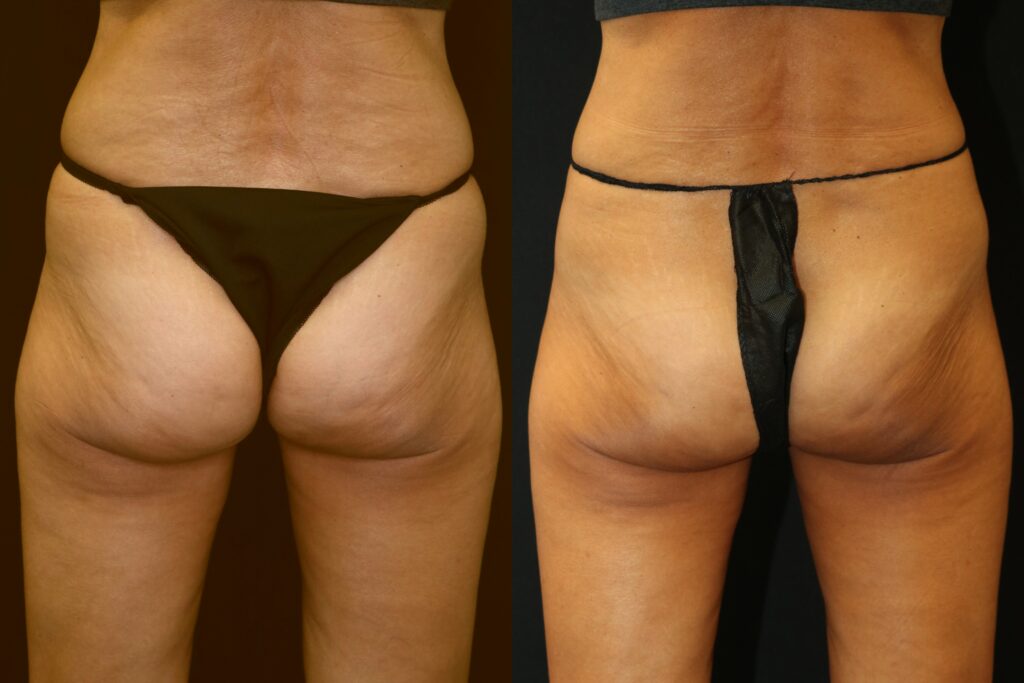 Coolsculpting