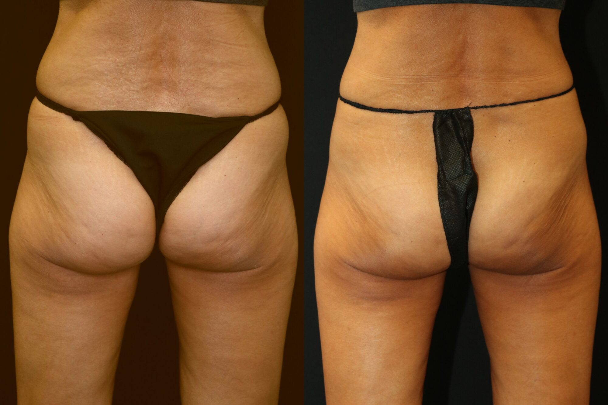 Coolsculpting