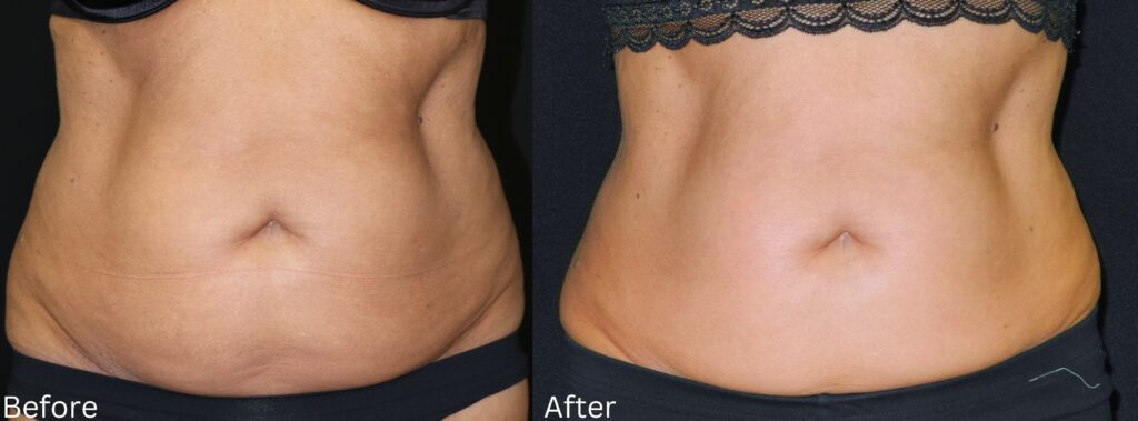 Cellulite Reduction