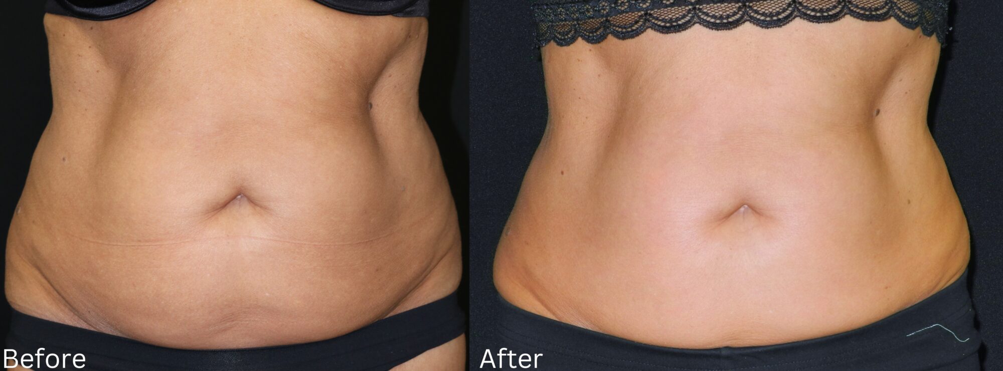 Cellulite Reduction