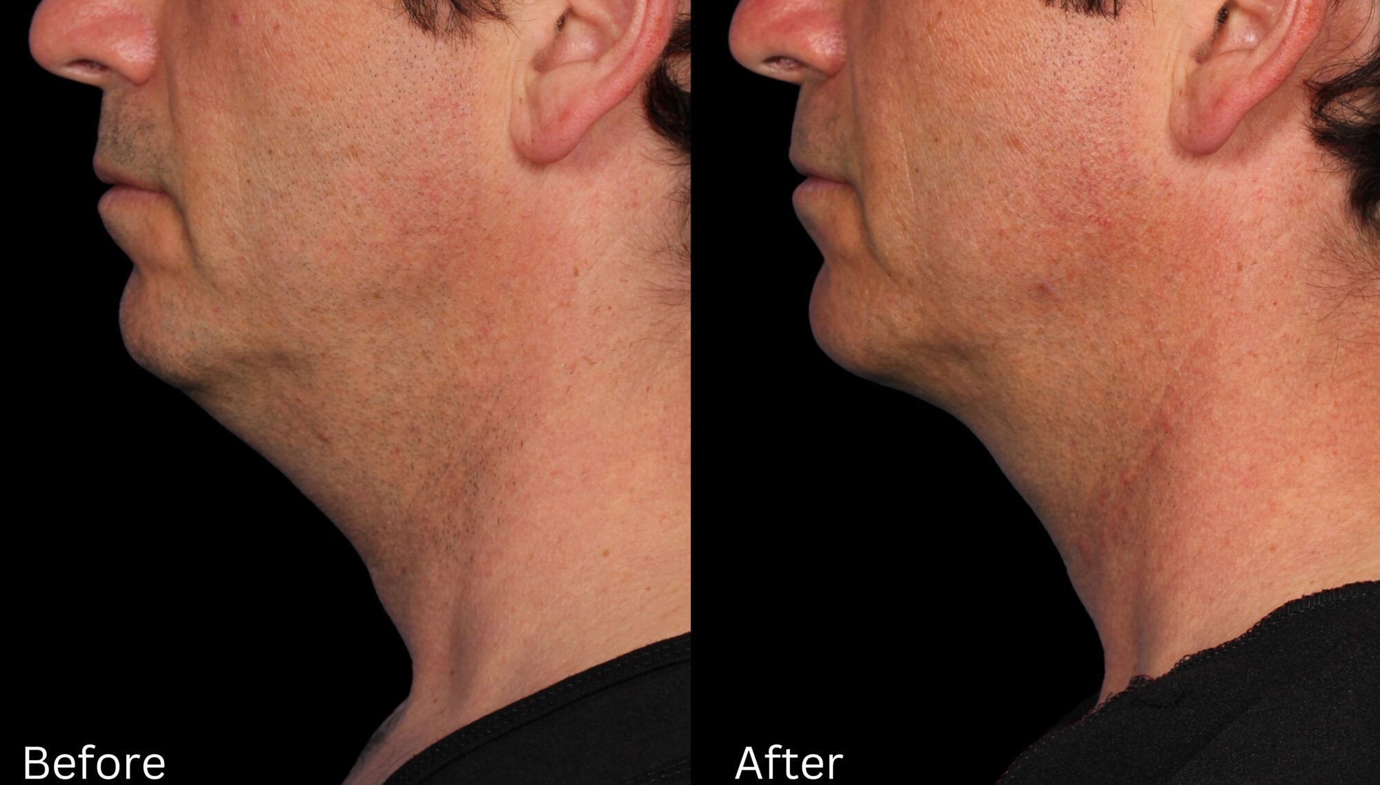Kybella